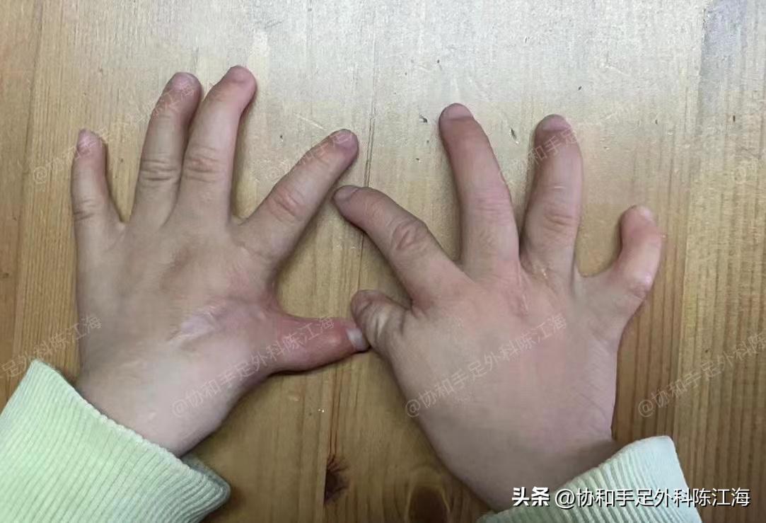 漂浮拇指治愈后样子,漂浮拇指治愈后图片