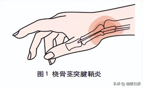 鼠标手键盘手症状及治疗方法,鼠标手键盘手腱鞘炎