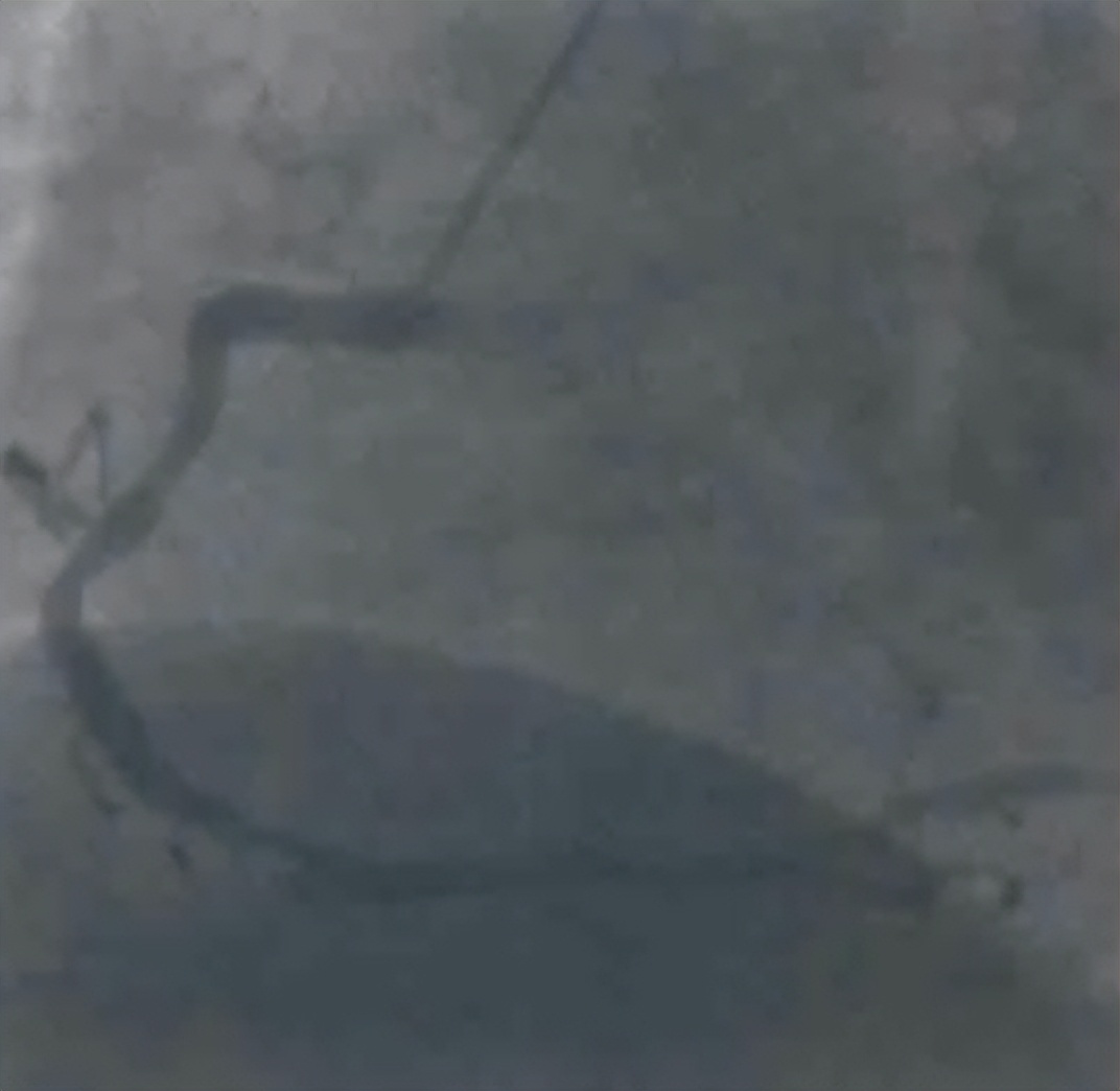 急诊PCI指南,急诊pci治疗费用