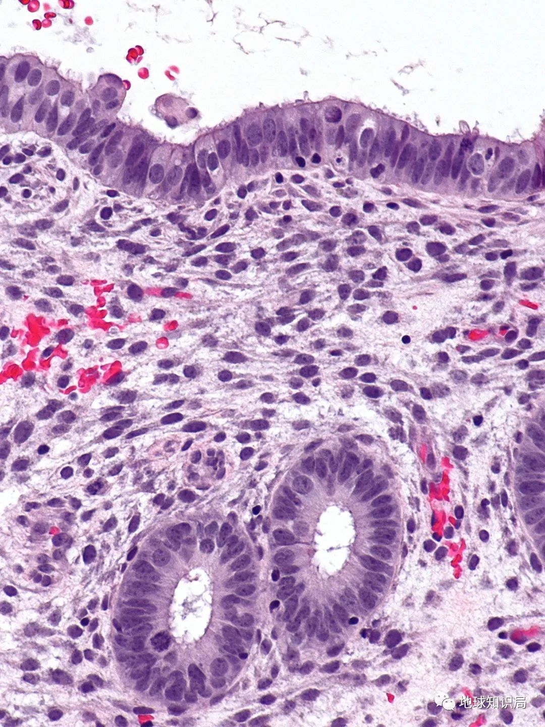 切除子宫的人会免疫力低吗,切除子宫的人寿命长吗