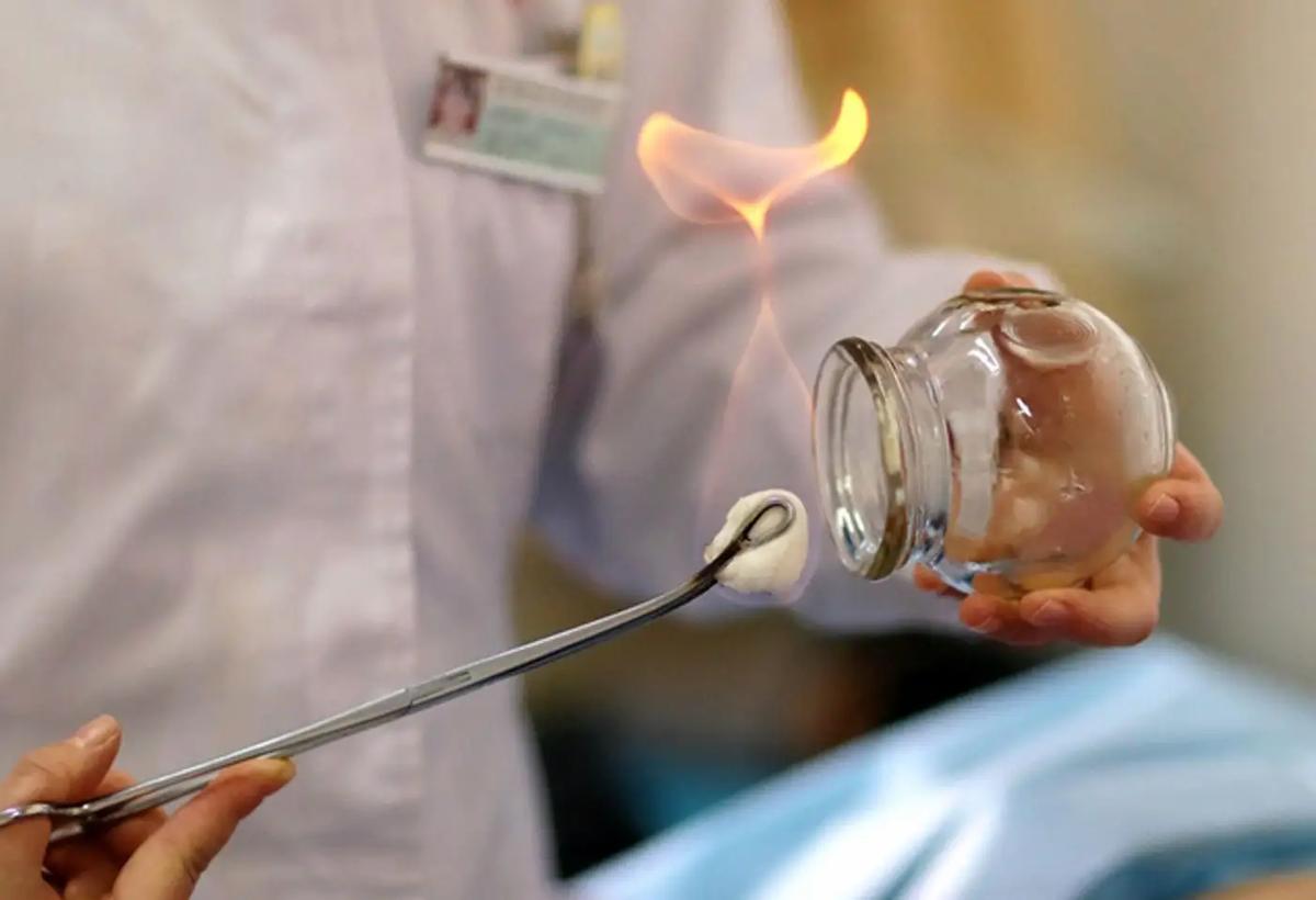 拔火罐吸出来的瘀血是毒素吗,拔完火罐后背上吸出来的瘀血