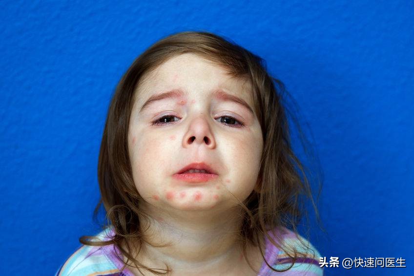 小孩出水痘发烧能喝板蓝根颗粒吗,孩子出水痘发烧能吃布洛芬吗