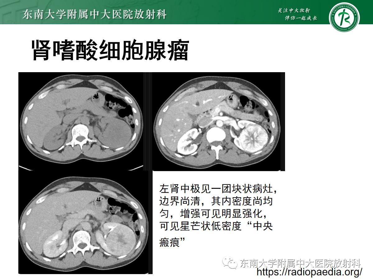 周利群谈肾嫌色细胞癌ct特点,好文分享值得深思