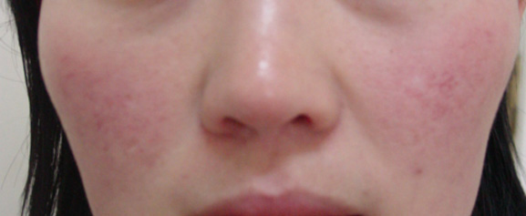 怎么修复脸部红血丝,怎么修复红血丝肌肤