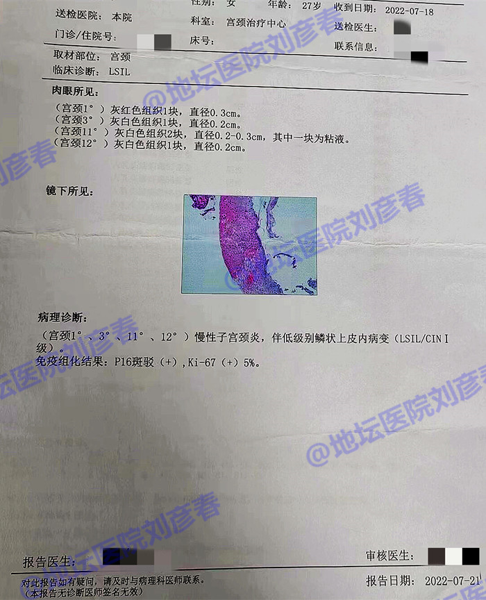 怎么治疗hpv宫颈糜烂,hpv感染到宫颈病变需要多久