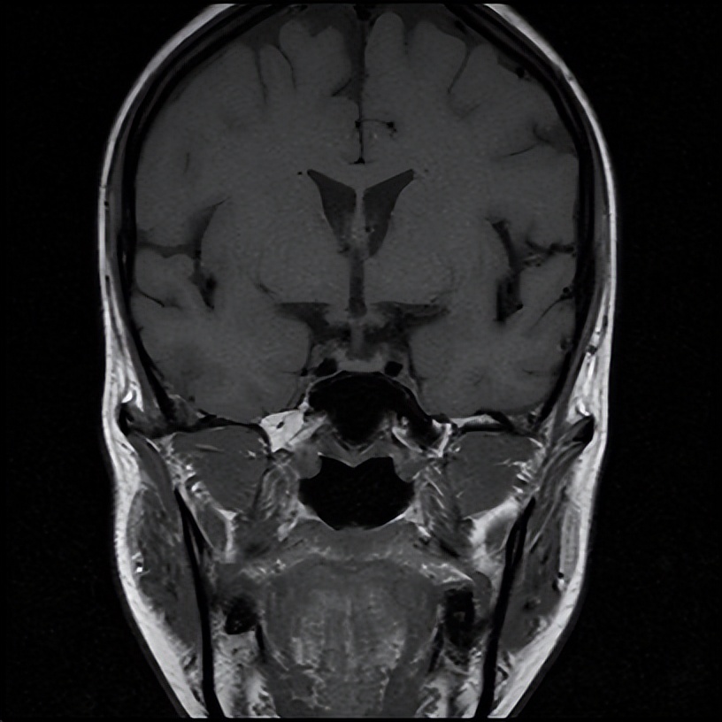头晕乏力不简单，抽丝剥茧解谜团——粤桂两地医生联手揪出背后“元凶”