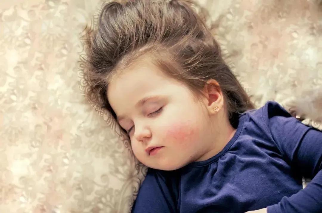 脸上皮肤过敏泛红起皮抹什么,皮肤过敏泛红干燥起皮怎么办