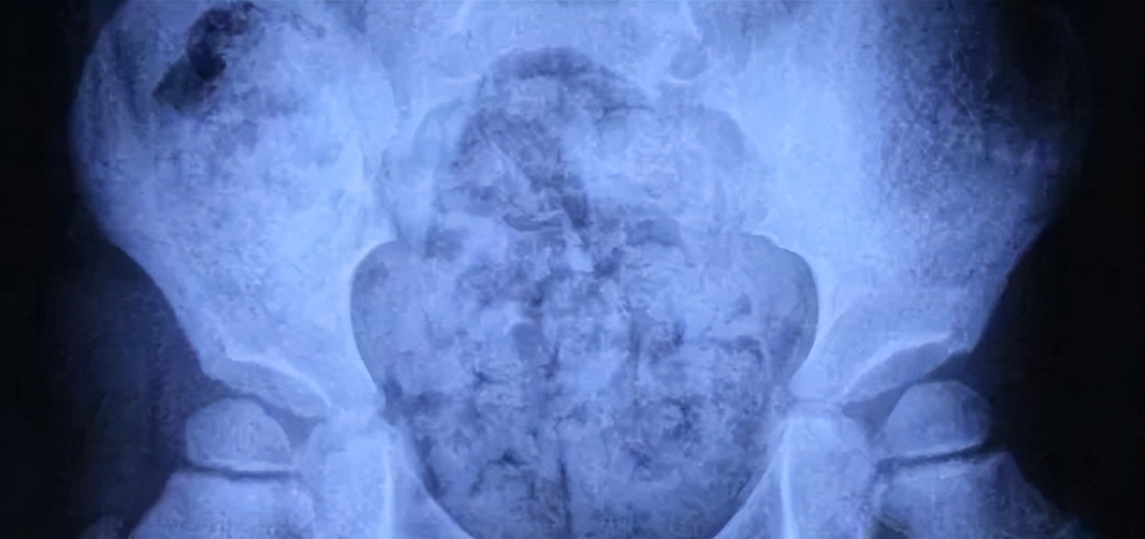 3岁女孩下身突然流血，医生的检查结果，原来是5厘米的异物