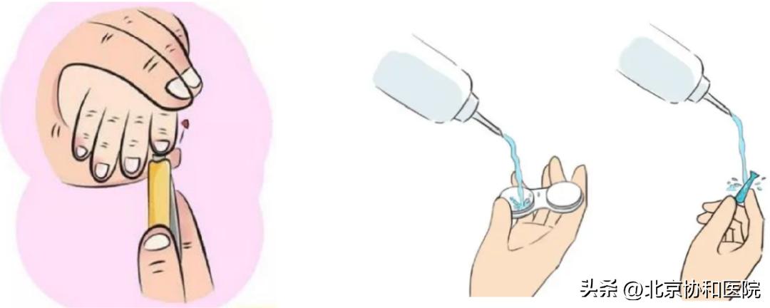 ok镜是怎么控制近视的,ok镜真的能治好初期近视吗