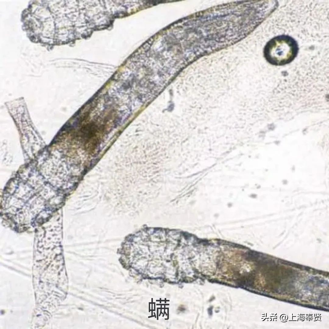 夏季被虫子咬了怎么办,夏季皮肤病攻略虫咬感染篇