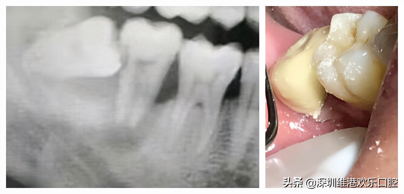 从医近30载，维港口腔高利民主任浅谈微创牙科学理念