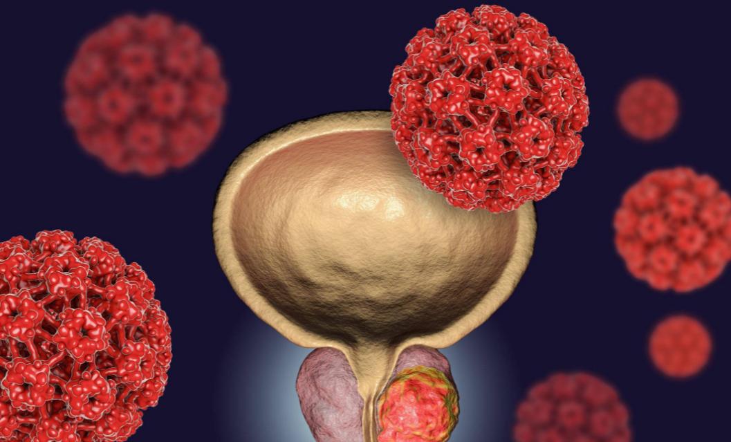 不论男女，身上长出这5种“瘊子”，或已感染HPV病毒！千万别轻视