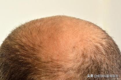 脱发族有救了？新研究：多吃这几类豆制品，可改善毛囊，防治脱发