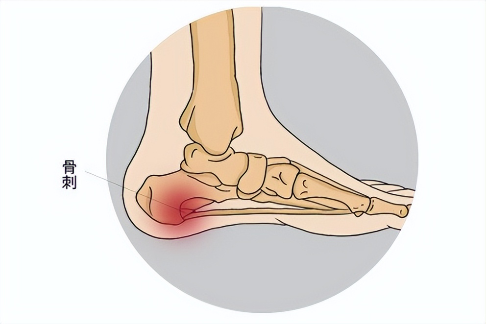 脚后跟疼是怎么回事有解决方法吗,脚后跟痛吃什么药缓解疼痛