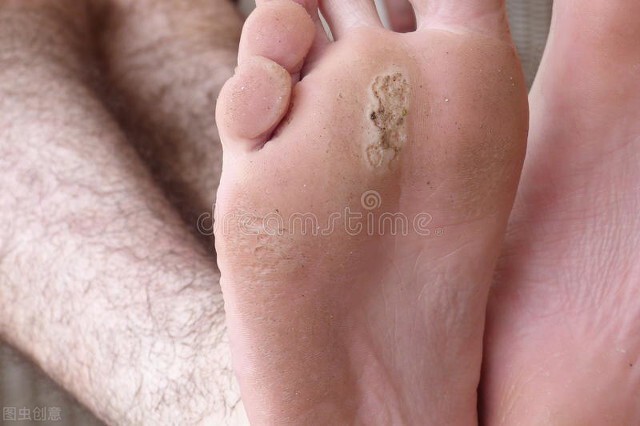 跑步鞋磨脚后跟处理4种方法,跑步磨脚是鞋子原因还是袜子原因