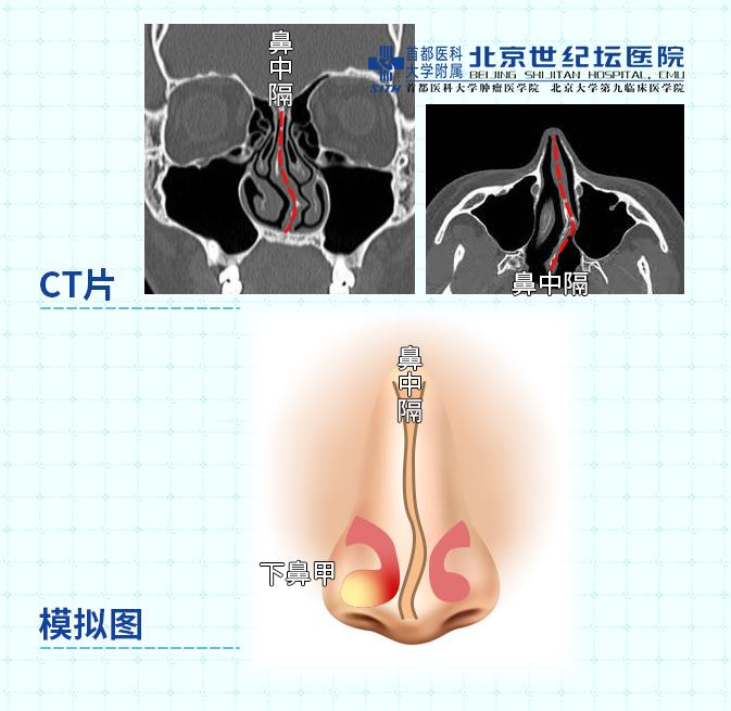 鼻炎手术怎么做要把鼻子切开吗,鼻炎手术的全过程