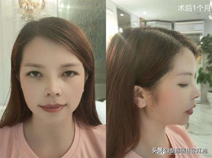 塌鼻子改小翘鼻,短塌鼻改直鼻微翘