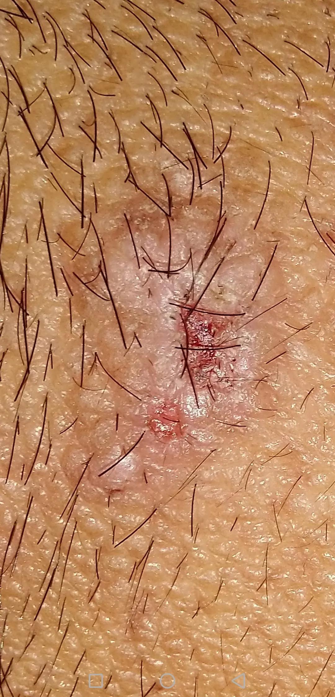 牛皮癣伴随一生是怎么样的体验,对抗牛皮癣一直在坚持