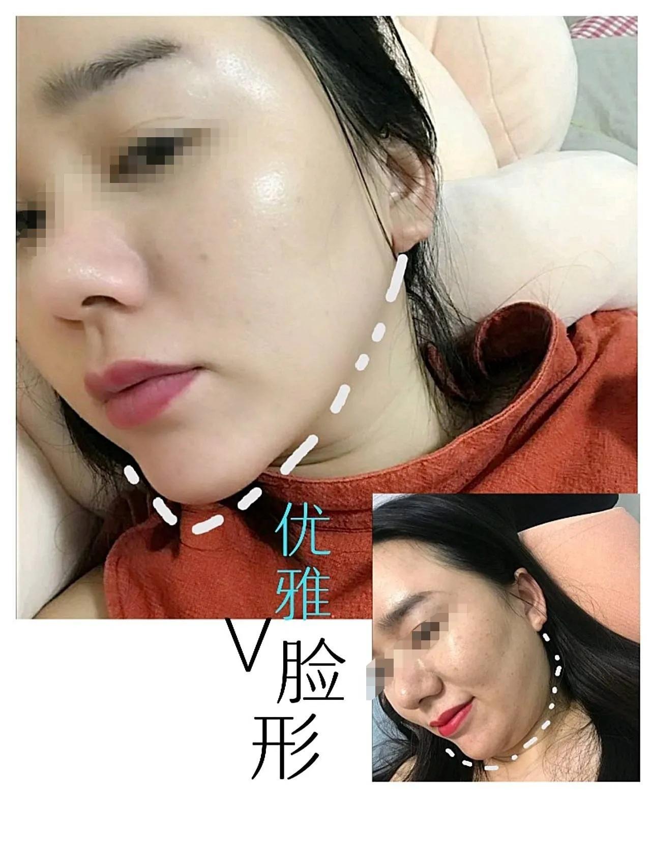 下颌黄金微雕恢复过程,正颌手术改善面中部凹陷