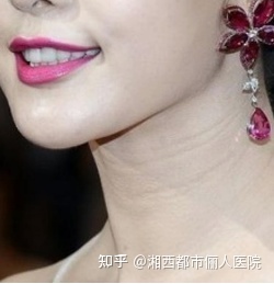 颈纹特别深怎么去除湘西都市俪人医院能做吗？