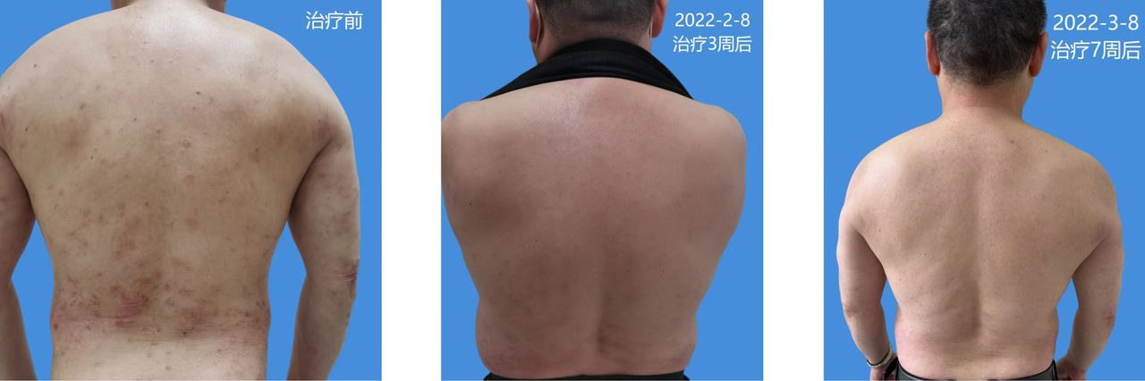 斑块型银屑病用什么单抗,银屑病阿达木单抗加重怎么办