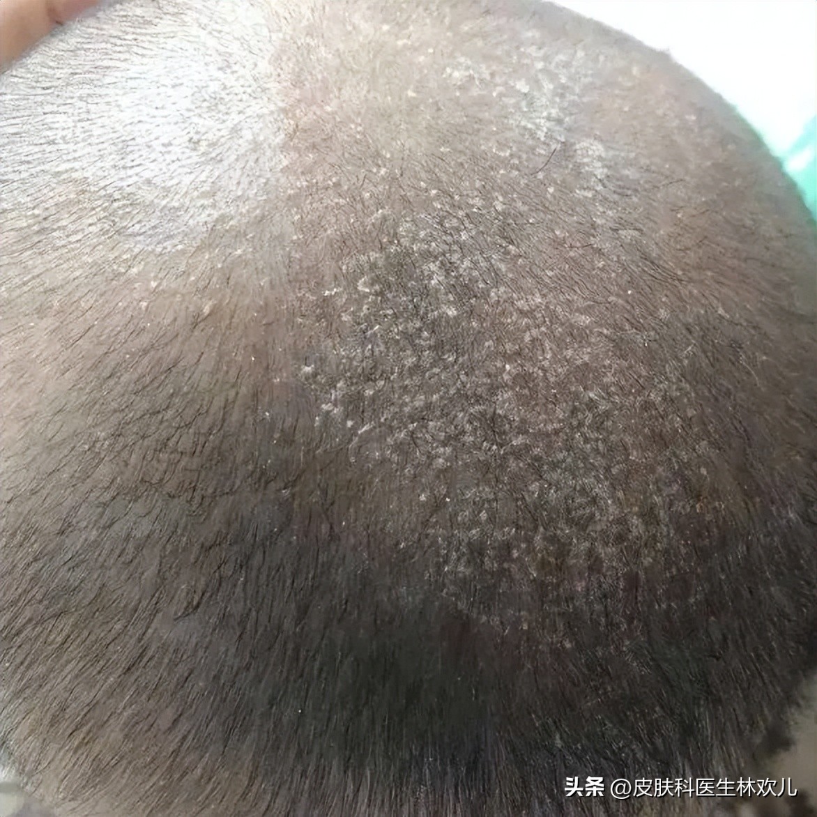 鼻翼两边泛红起皮抹芦荟胶有用吗,鼻翼两侧泛红起皮黄色结痂