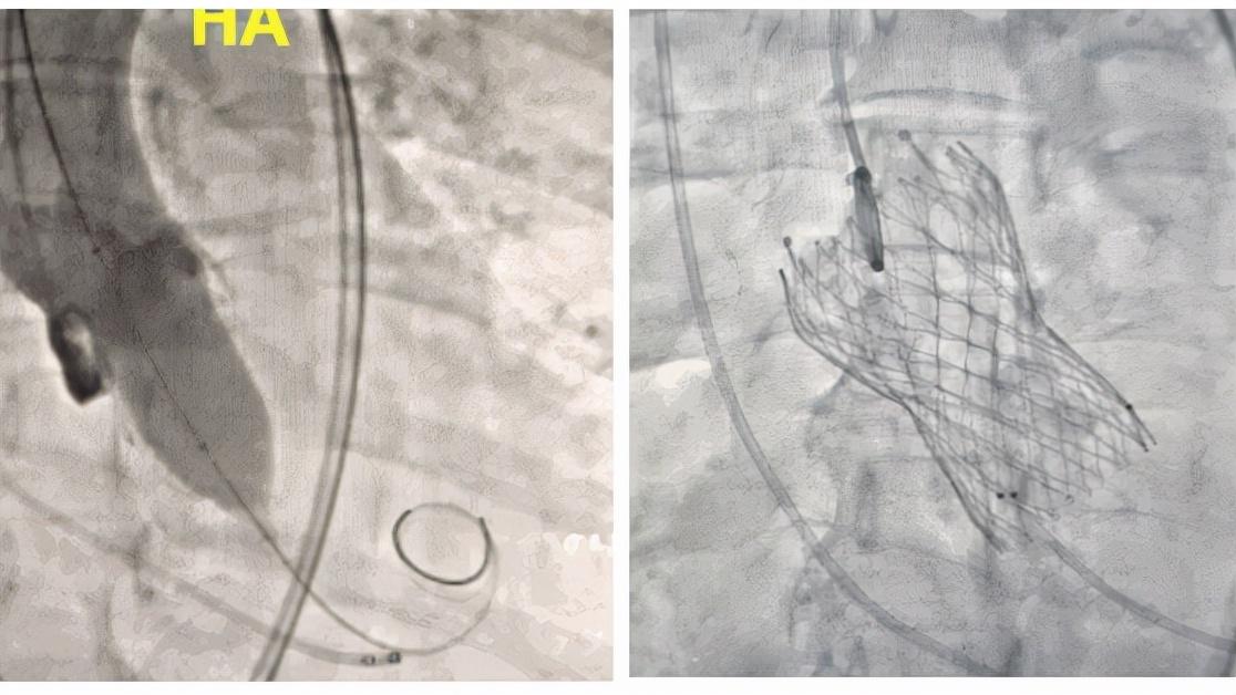 心脏瓣膜病手术具体怎么做,心脏瓣膜病什么程度需要手术