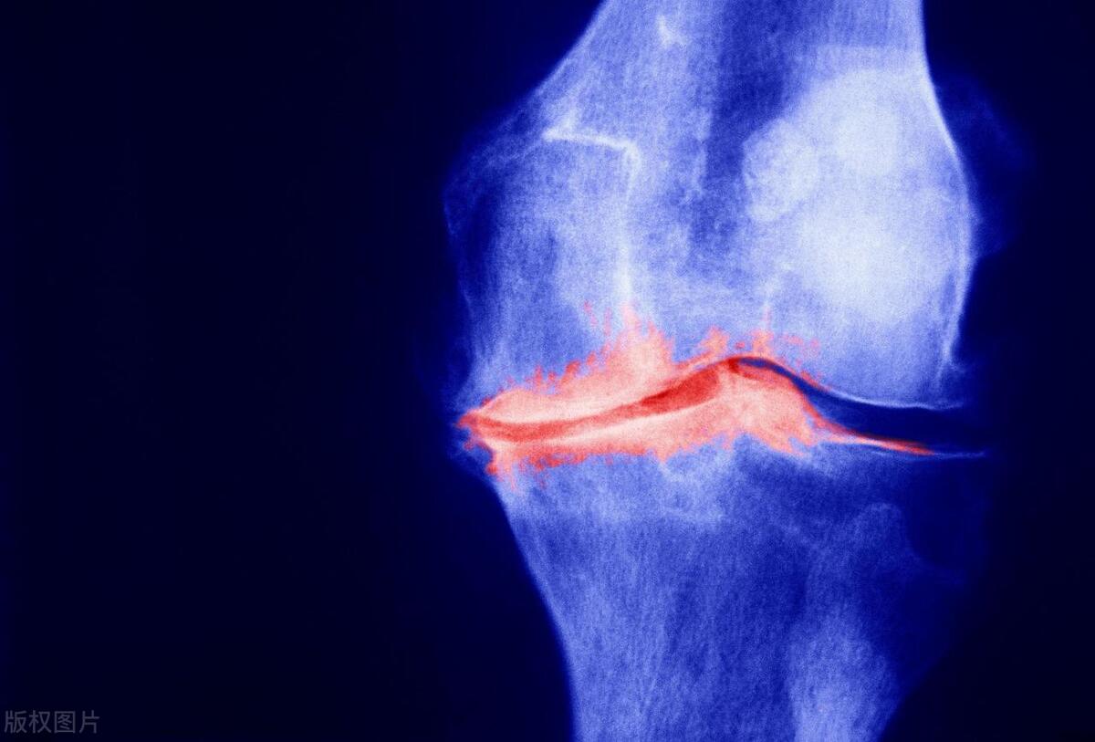 手臂关节炎的症状表现,儿童关节炎症状表现