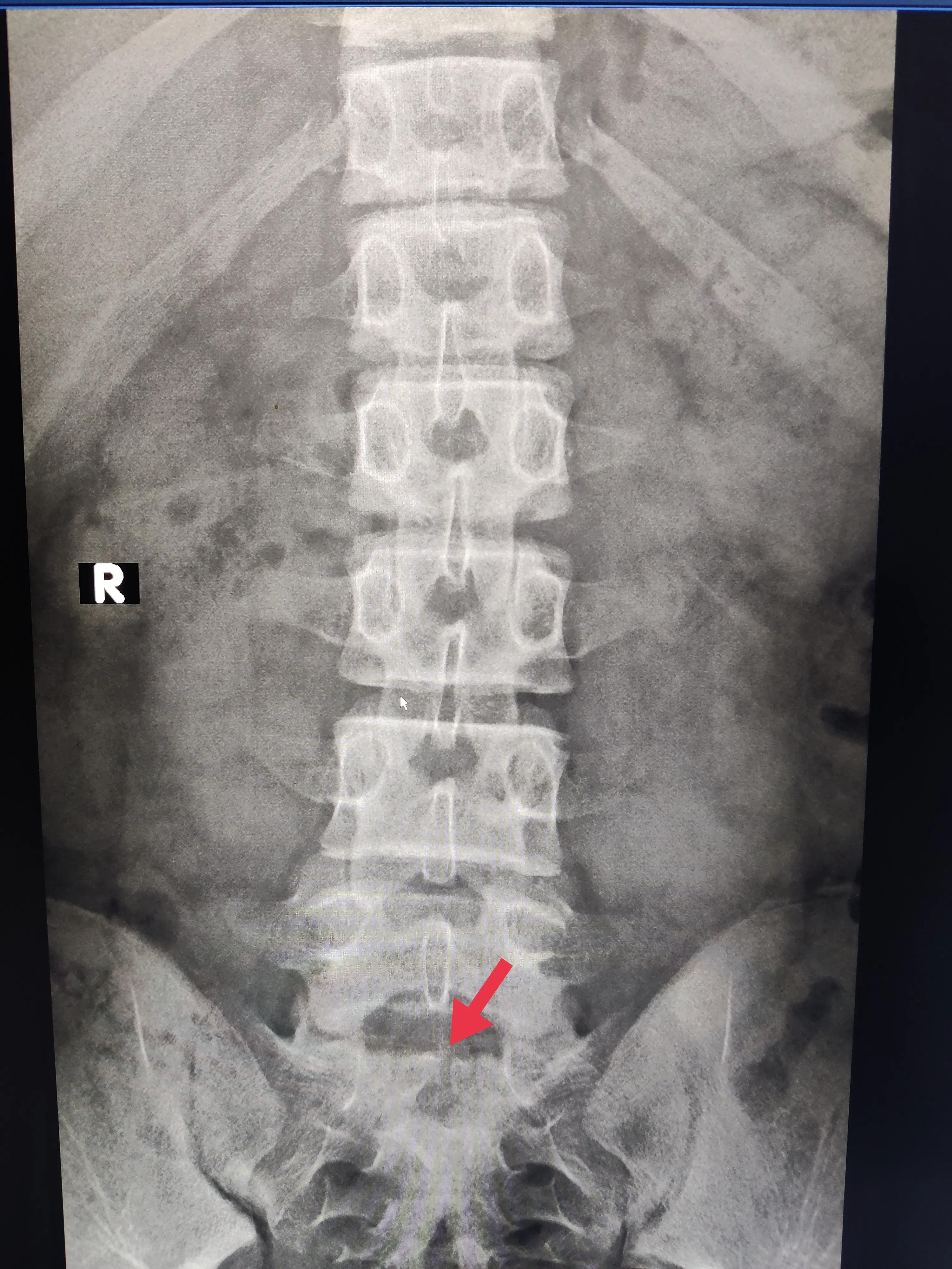 10岁小孩腰弓驼背吃什么好,驼背和休门氏病的区别