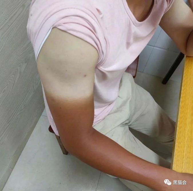 2天搭建，严重晒伤…看活动人“花式防晒”