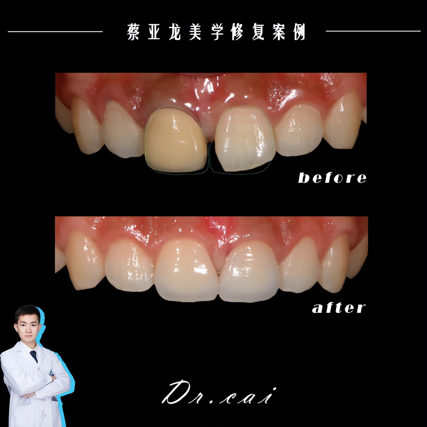 贵阳门牙牙缝大牙齿矫正,长沙牙齿疏松缝隙大矫正