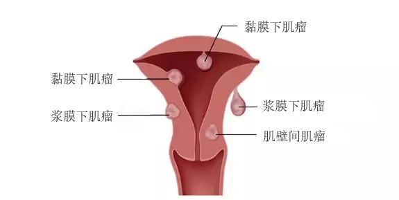 子宫肌瘤很多像葡萄串一样好不好,子宫肌瘤像一串葡萄一样