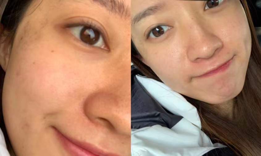 收缩毛孔激光点阵真实效果,毛孔缩小最有效的办法用点阵激光