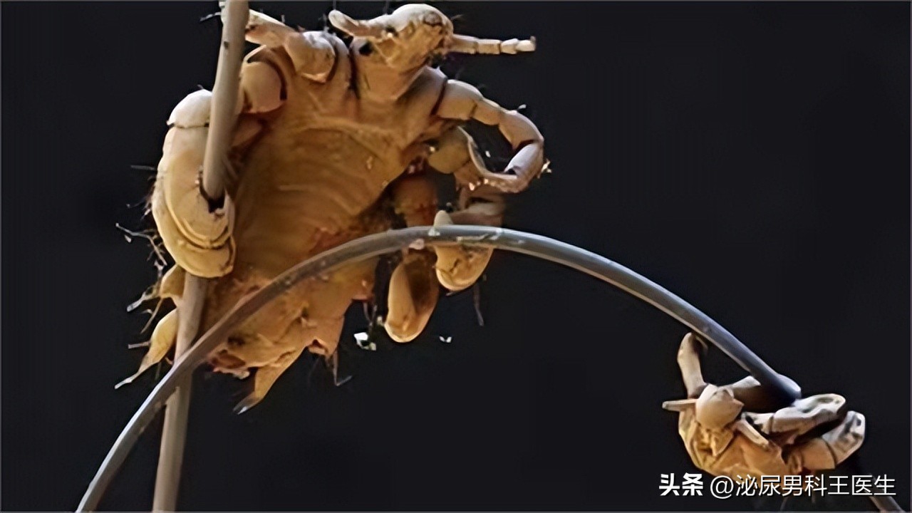 一男子腹部痒，医生用镊子夹出16只阴虱！原来阴虱有3个传播途