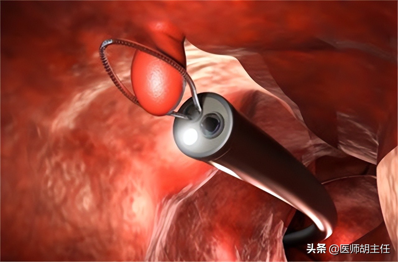 如果肠道长息肉身体会有哪些反应,肠道长息肉会有什么症状