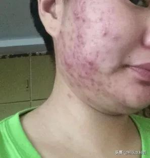 青春痘怎么形成,青春痘怎么去除方法有哪些