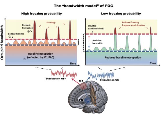 世界帕金森病日第28个主题,世界帕金森病日完整版