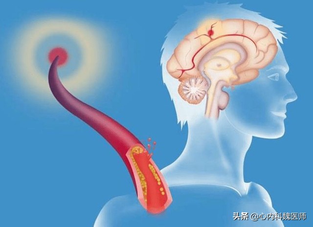脑梗病人吃叶酸和b12b6起什么作用,老年人预防脑梗如何补充叶酸和b12