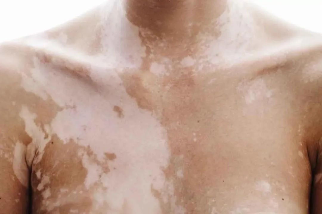 白癜风照了之后发红是怎么回事,白癜风体味臭