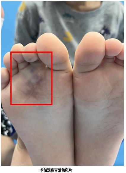 疣状静脉畸形介入治疗,下肢静脉畸形介入手术全过程