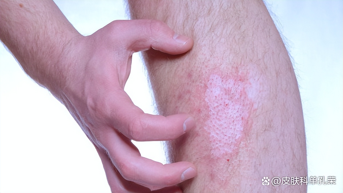 白斑发红发痒是什么原因,白斑痒了是意味着白斑发展了吗