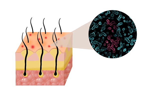头皮屑特别多跟用洗发水有关系吗,头皮屑与更换洗发水有关吗