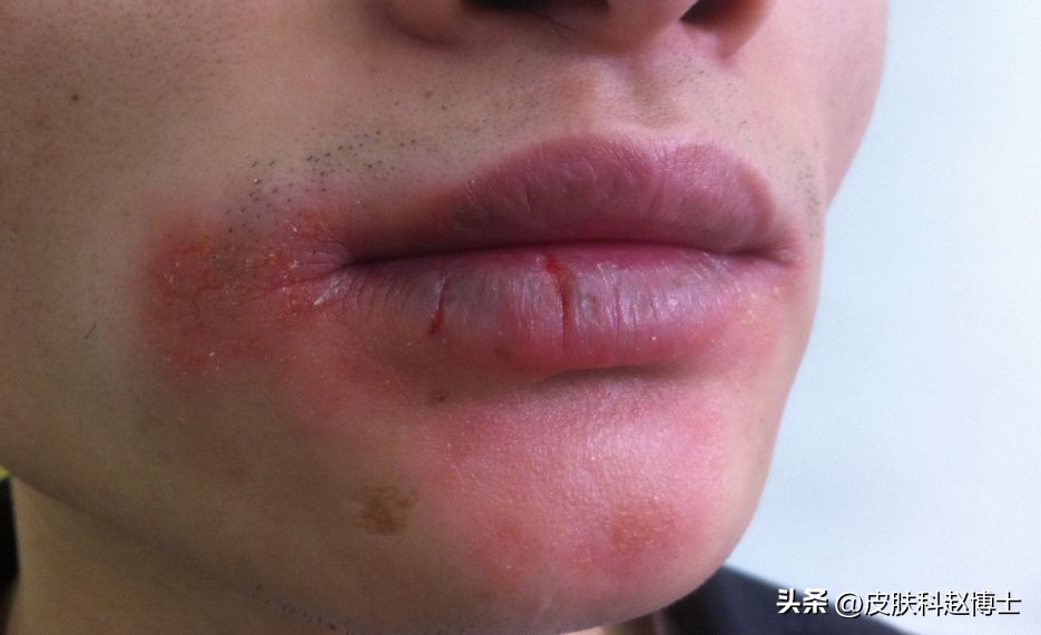 过敏湿疹反复发作如何除根,湿疹反复发作找不到病因