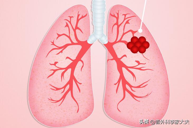 肺癌淋巴转移用消融治疗效果好吗,肺癌淋巴转移吃靶向药能治愈吗