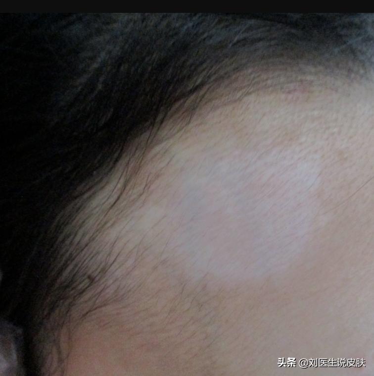 什么是白癜风和白斑有什么区别,是不是白癜风长在手上比较难治