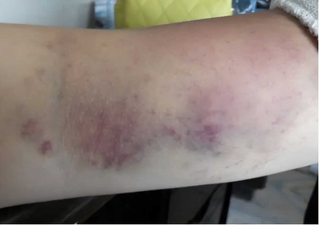 筋膜枪功效与禁忌,筋膜枪怎么用详解三大隐患缺点