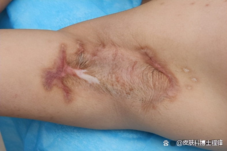 做完腋臭微创手术复发几率,腋臭手术后复发了怎么调理排毒