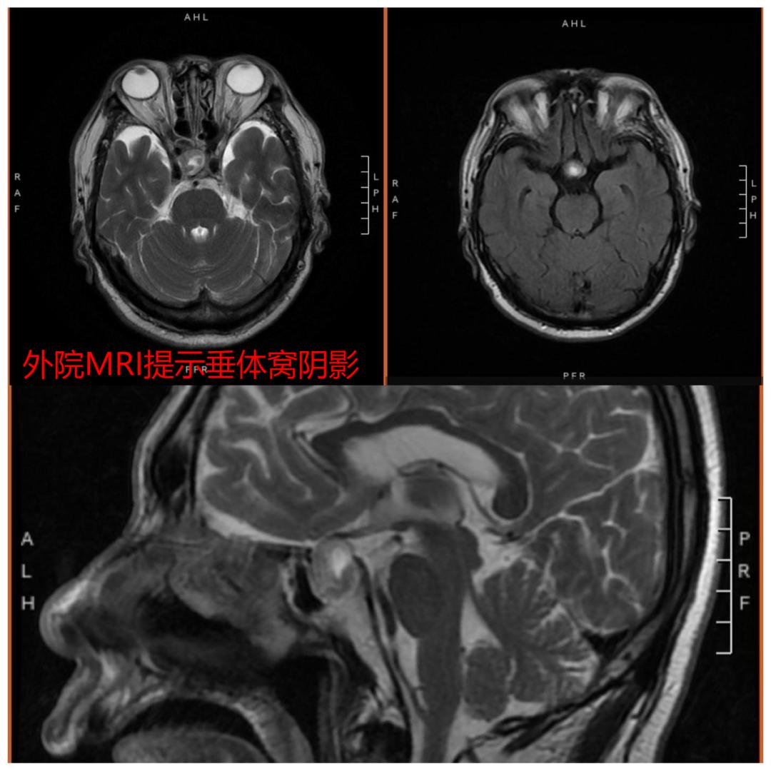 抢救失去的光明——市中心医院神经外科急症切除脑垂体瘤卒中一例