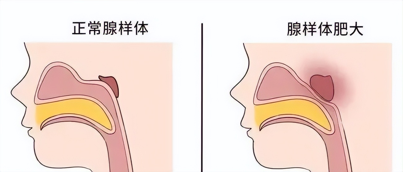 腺样体肥大如何诊断检查呢,腺样体肥大中医诊断是什么