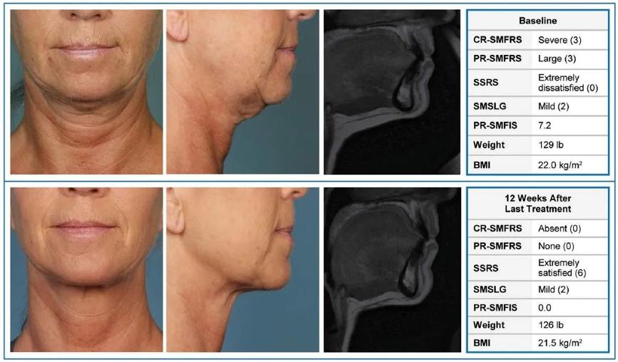 整形医生都不碰的医美项目溶脂针,最强的溶脂针